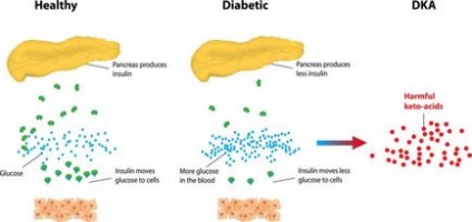 Simptome de comă diabetică, îngrijire de urgență și consecințe