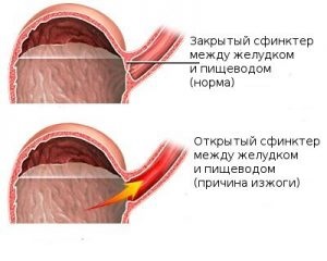 Дієта при печії основи правильного харчування, меню