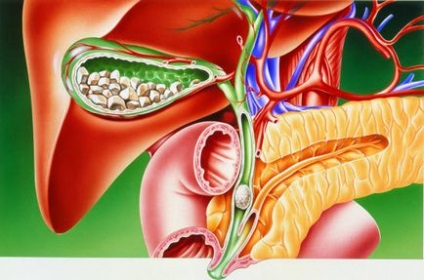 Dieta pentru colecistită și pancreatită, un meniu aproximativ, pancreatită