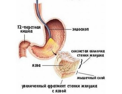 Dieta cu tratament ulcer gastric după intervenție chirurgicală sau exacerbare