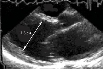 Diureticele în terapia modernă a insuficienței cardiace cronice