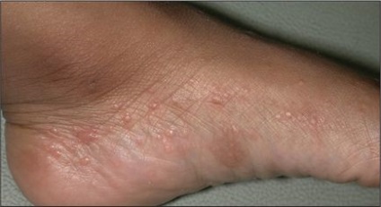Eczemă pe mâini - cum să tratezi etapa inițială