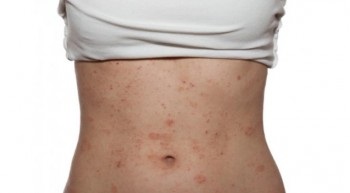 Eczema variantă, stadiul de dezvoltare și boala foto, jurnalul online - alergie