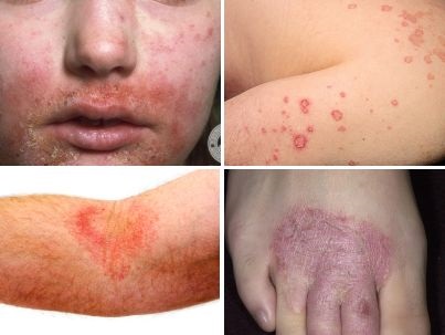 Eczema variantă, stadiul de dezvoltare și boala foto, jurnalul online - alergie