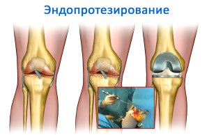 Evoluția artroplastiei patelare, Dr. Sult