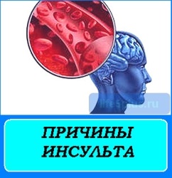 Флорешти - причини інсульту і профілактика