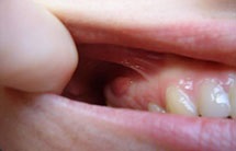Fluxul pe gingii - ceea ce este periculos atei dentare la copii și adulți, cauzele și simptomele