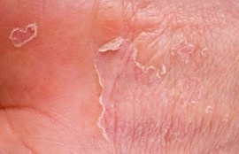 Formele, tipurile și clasificarea eczemelor pe picioare, mâini, față