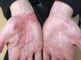 Formele, tipurile și clasificarea eczemelor pe picioare, mâini, față