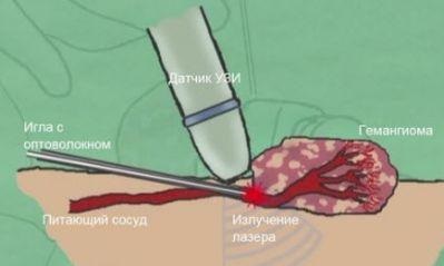 Hemangiomul de la Moscova