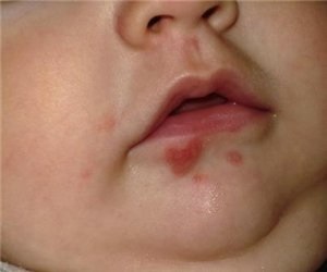 Herpes la copil semne, cauze și tratament