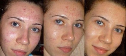 Gelolic peeling la domiciliu atunci când puteți face, ce soluție de a utiliza, fotografii și clipuri video