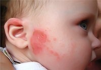 Dermatită fungică în tratamentul copiilor