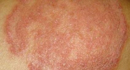 Dermatită fungică la simptomele sugarilor și adulților, tratament