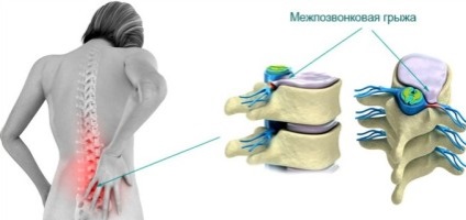 Herniated disc intervertebral formă și tratament gimnastică