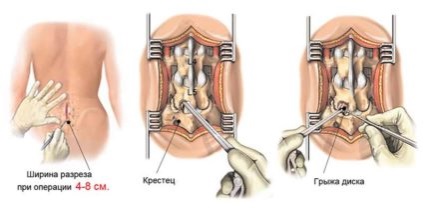 Hernia coloanei vertebrale - cauze și semne ale bolii