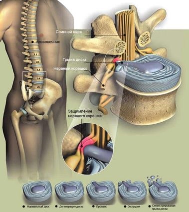 Hernia coloanei vertebrale - cauze și semne ale bolii
