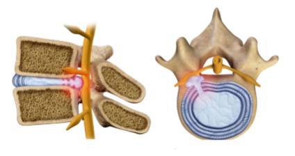 Hernia coloanei vertebrale - cauze și semne ale bolii