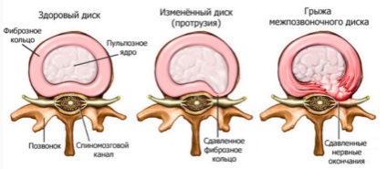 Hernia coloanei vertebrale - cauze și semne ale bolii