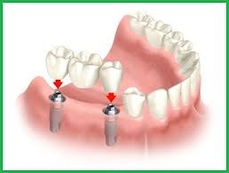 Implanturi conet implant de dinți, implanturi dentare (implanturi)