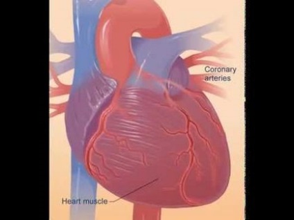 Infarctul miocardic ce este, care sunt soiurile și cauzele