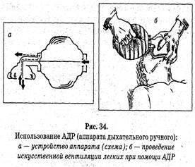 Mesterséges tüdőventilációs (ALV)