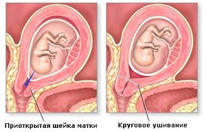 Як роблять узі шийки матки при вагітності