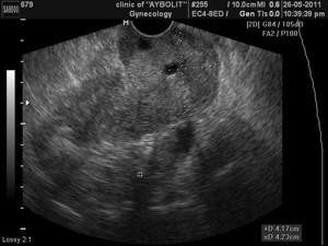 Cum uzează colul uterin în timpul sarcinii