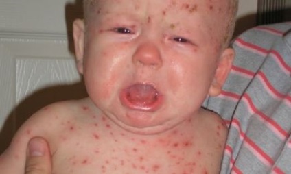Cum se trateaza varicela la copii
