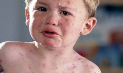 Cum se trateaza varicela la copii