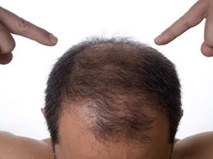 Hogyan lehet megállítani hajhullás a férfiak