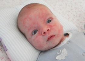 Cum se manifestă alergia la copil și cum se poate distinge de alte boli?