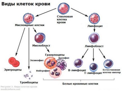 Cum apare leucemia limfoidă?