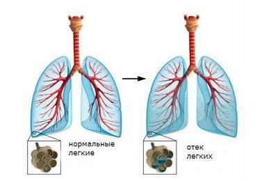 Tuse cu edem pulmonar cauzele, simptomele și tratamentul
