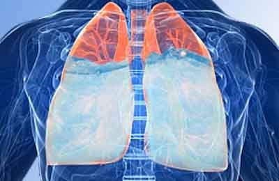 Köhögés tüdőödéma okoz, tünetek és a kezelés