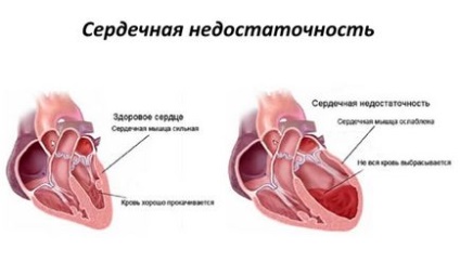 Tuse în insuficiență cardiacă - simptome, tratament, la vârstnici