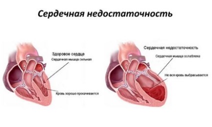 Кашель при серцевій недостатності - симптоми, лікування, у літньої людини