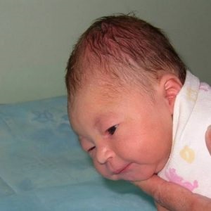 Кефалогематома у новонароджених наслідки, лікування, пункція і видалення