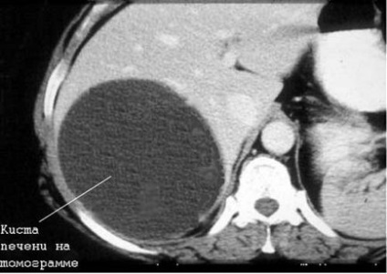 Chistul ficatului, cauzele și simptomele chistului hepatic, tratamentul și funcționarea