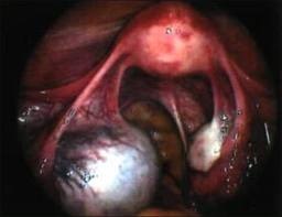 Ovarian chist - tratament