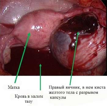 Кіста жовтого тіла