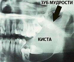 Chisturile maxilare - cauze, simptome, diagnostic și tratament