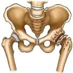Коксартроз що це таке, фото тазостегнового суглоба