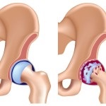 Коксартроз що це таке, фото тазостегнового суглоба