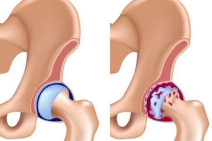 Coxartroza articulației șoldului - simptome și tratament