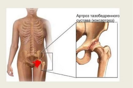 хип коксартроза - симптоми и лечение