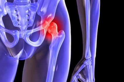 hip coxarthrosis - tünetek és kezelés