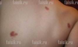 Red moles pe corp - cauzele apariției și tratamentului