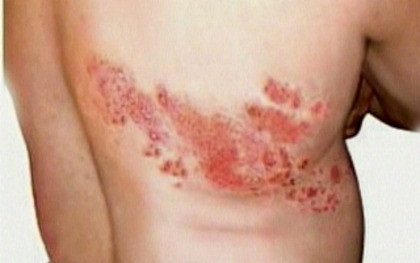 Tratament roșu cu lichen, fotografie