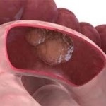 Acolo unde cancerul intestinului dă metastaze